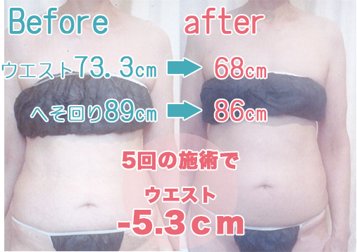 写真:メディセル施術