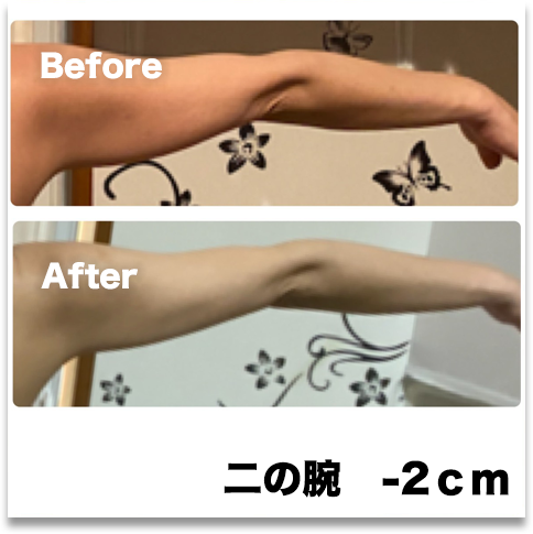 4Dハイフ施術