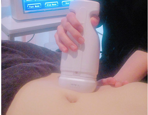 ハイフ施術