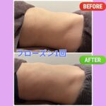 フローズンリフトプロ☆モニター様(^o^)／